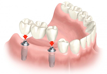 protesi dentarie - implatologia